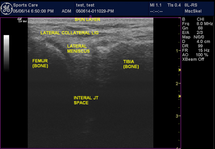 MSK Ultrasound of IT Band - Huntington Beach Sports, Orange County CA