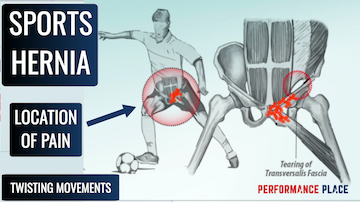 Got Sports Hernia?  Dynamic Chiropractic